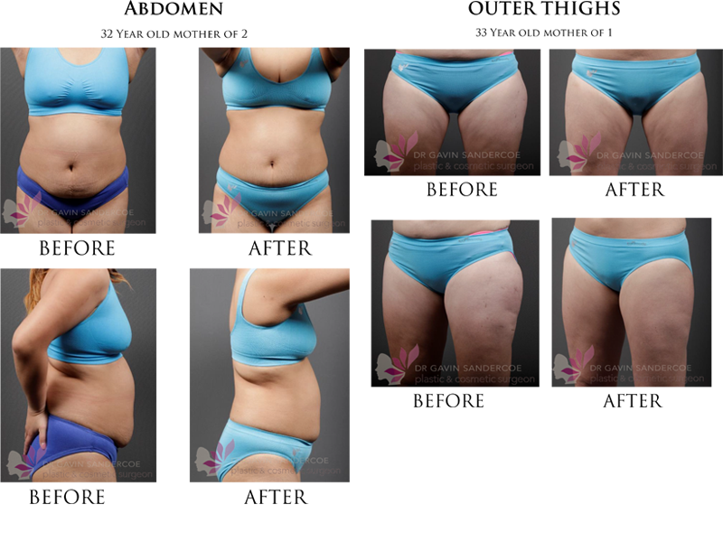 CoolSculpting Get Started To A Slimmer You - Dermaster